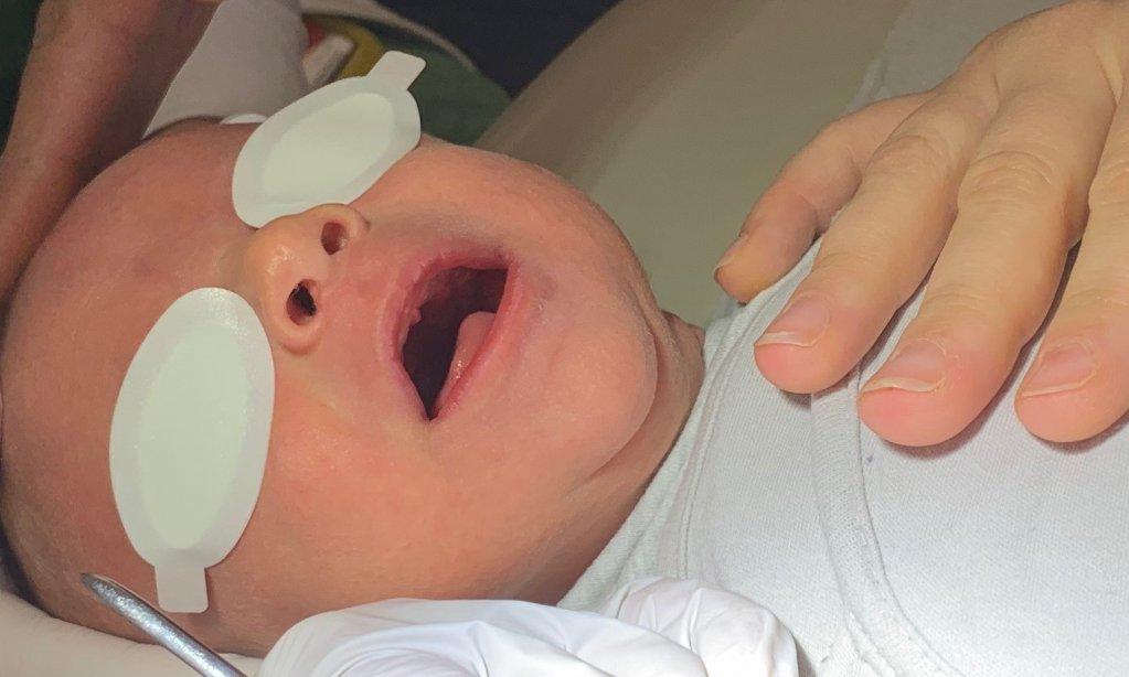 Zungenbandtrennung mit dem CO2-Laser bei einem Baby