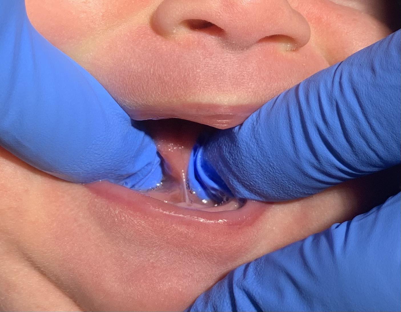 Zungenbandtrennung mit der Schere