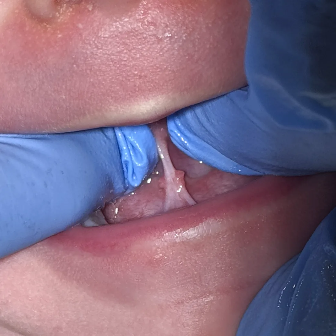 Verkürztes Zungenband beim Säugling: gespanntes Frenulum bei angehobener Zunge während der Untersuchung